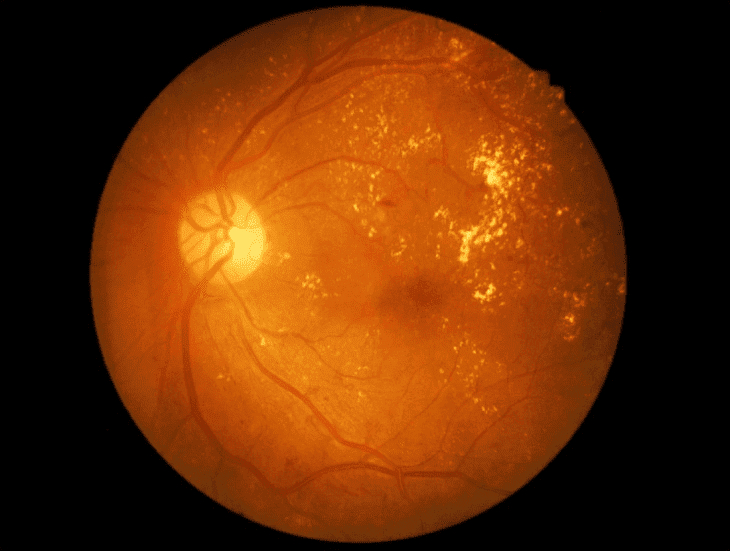 Retina Image of a Person with Diabetic Retinopathy Retina Image of a Person with Diabetic Retinopathy
