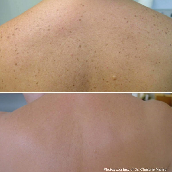before-after-skin-treatments-5