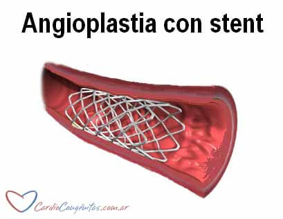Angioplastia-con-stent-figura