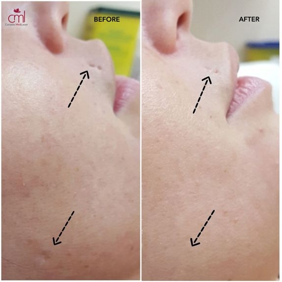before & after Skin Procedures in Toronto