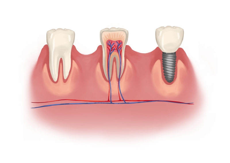 Dental implant next to natural teeth