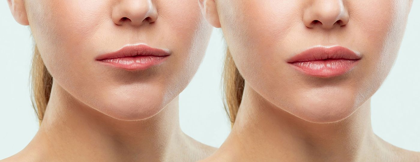 lip fillers in thornhill before after