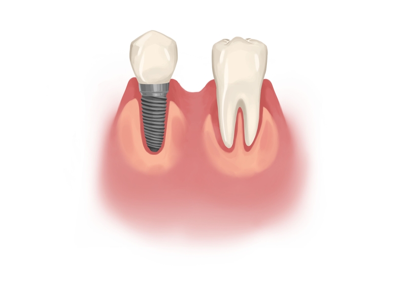 Single dental implant next to natural back tooth 