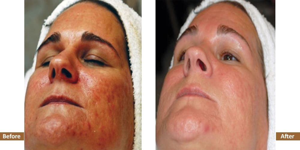 Rosacea Before & After Treatment Image