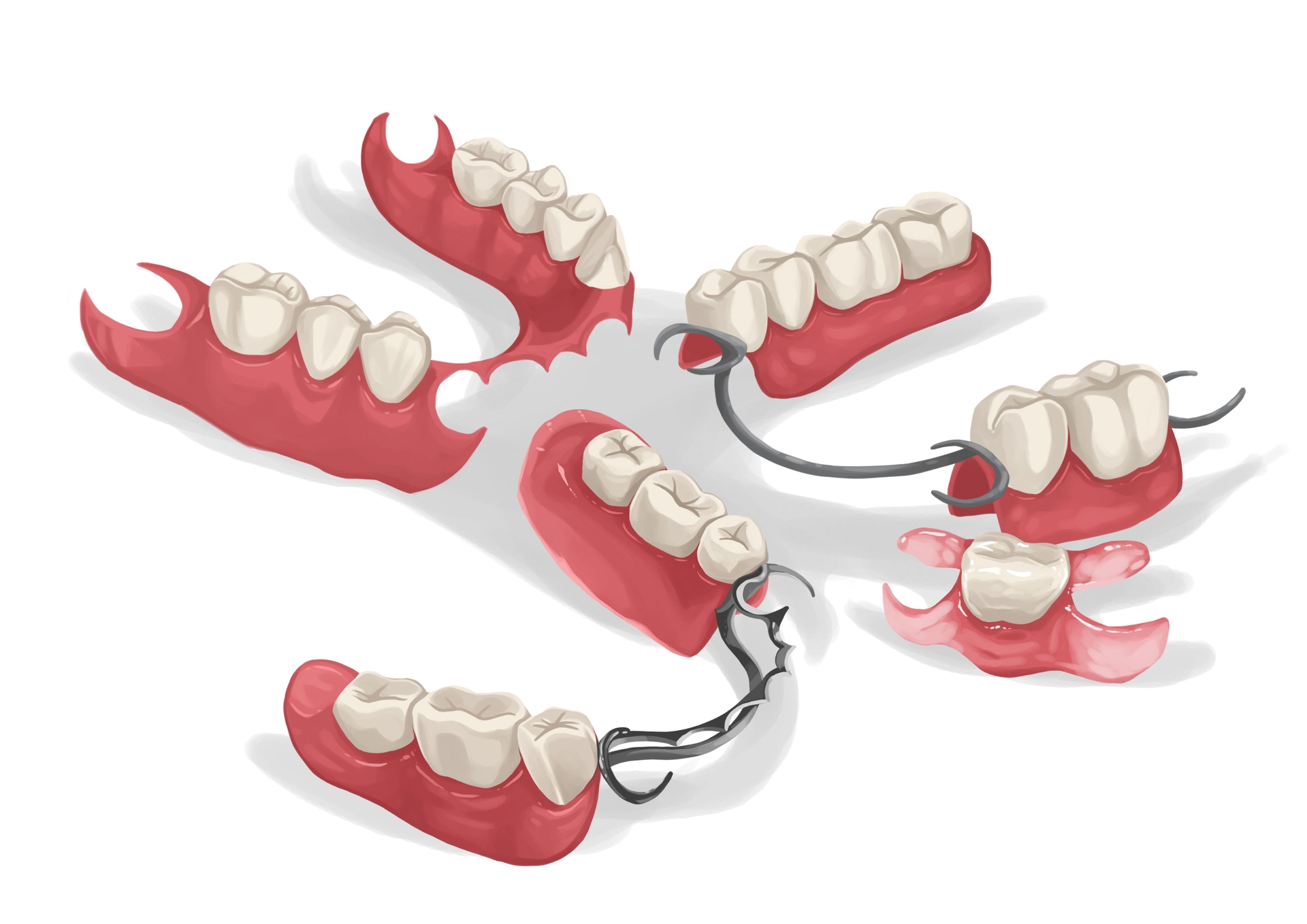 Dentures types (partial, full) and procedure Authority Dental