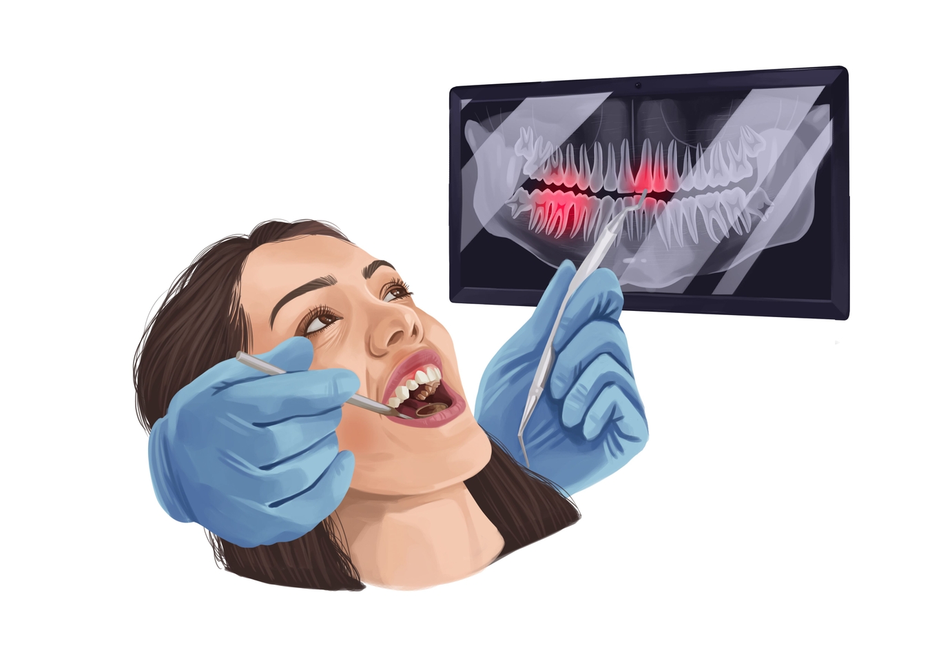 Tooth extraction costs from 50 up to 1,100