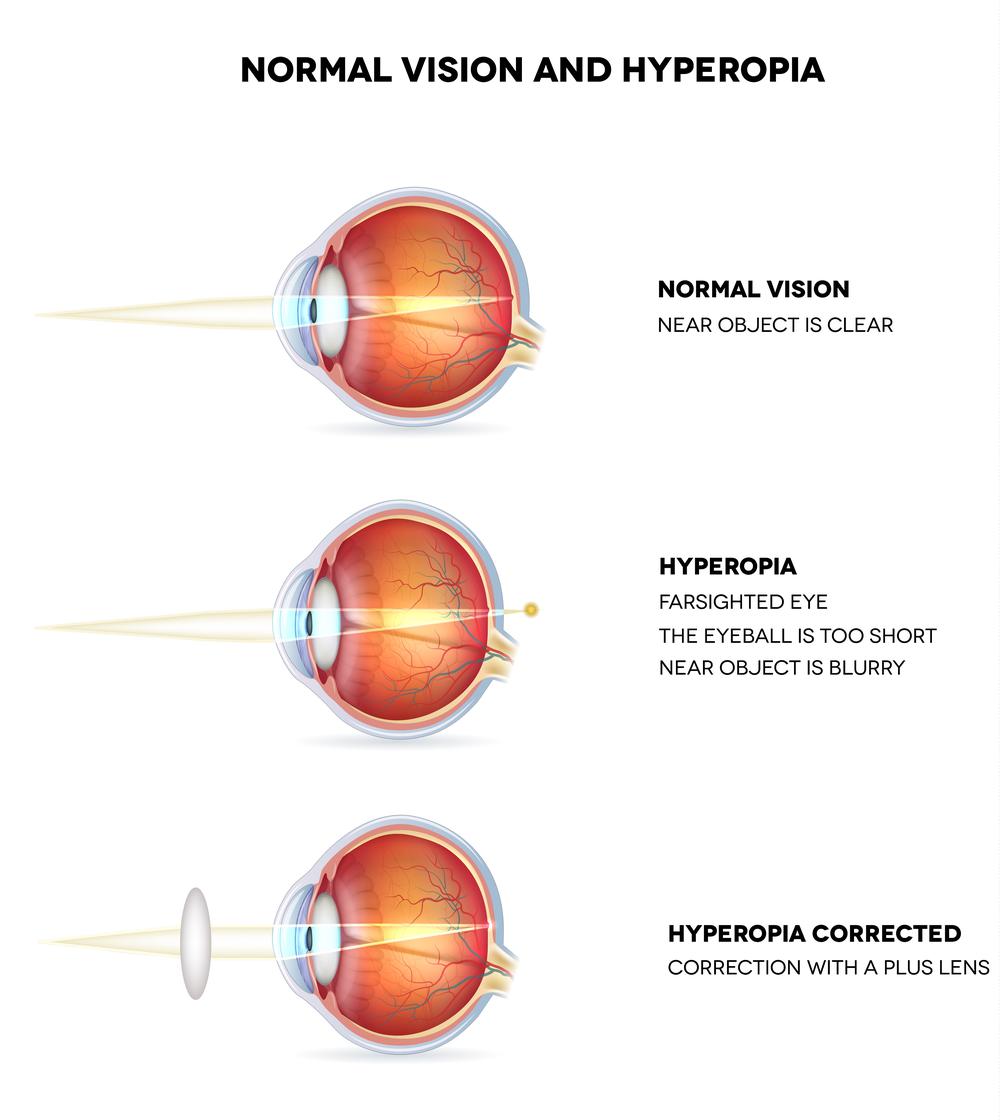 hogyan alakul ki a hyperopia látásélesség-helyreállítási módszer