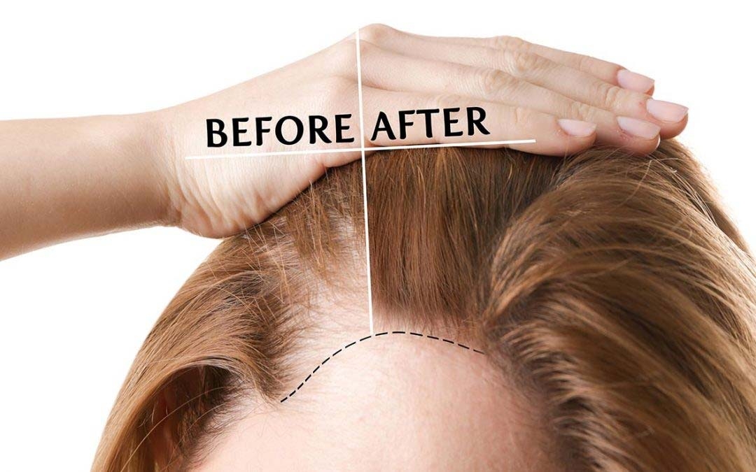 Hair Transplant Toronto Hair Restoration Ontario