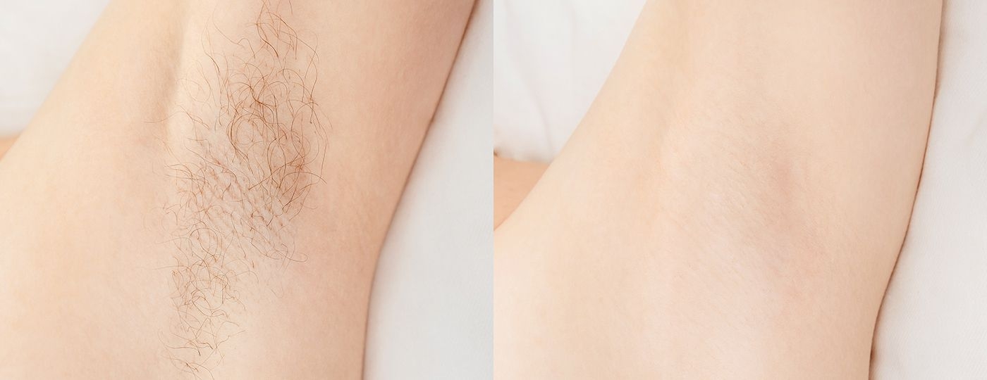 laser hair removal in thornhill before after