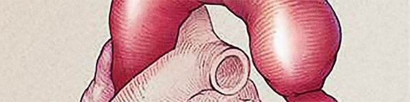 Coarctatia de aorta | Centrele Ares | Inovație în Cardiologie
