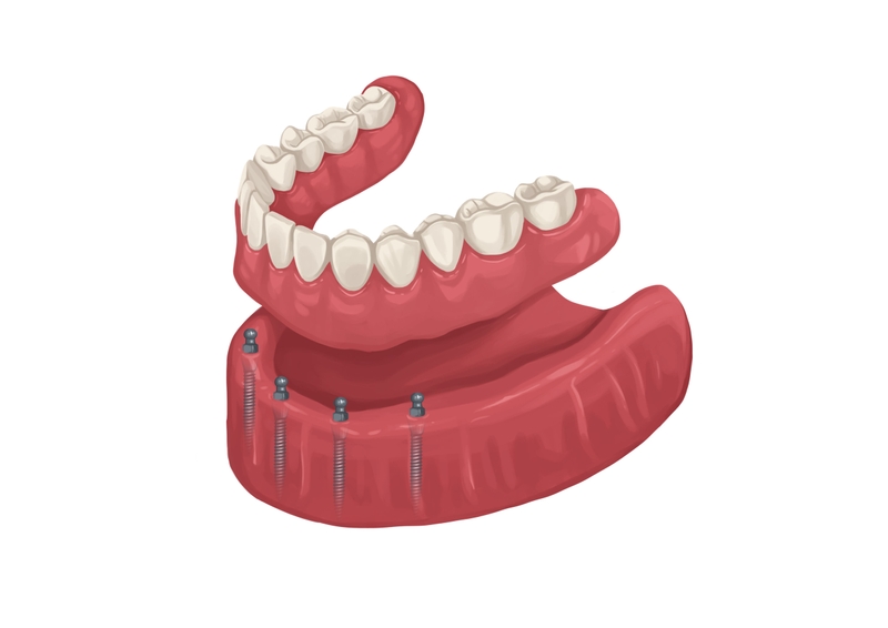Dentures supported by four mini implants