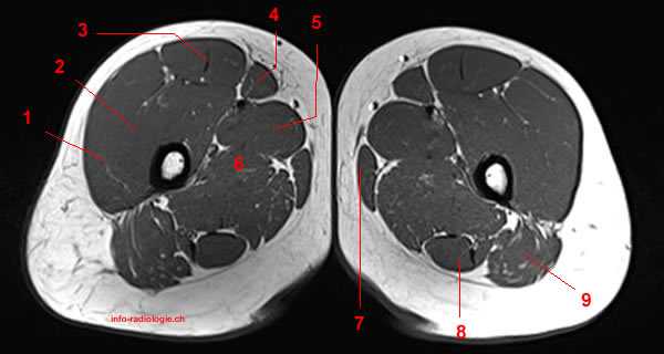 MRI of the Thigh: Detailed Anatomy (Superior Part)