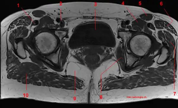 Mri Of The Hip Detailed Anatomy W Radiology