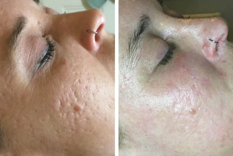 Acne Scars Revision Ottawa Safe & Effective Treatment For All Skin Types