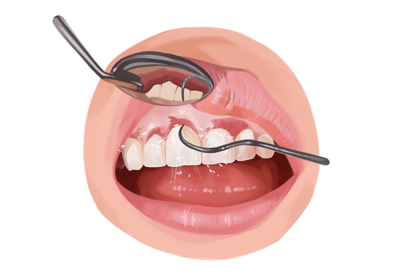 Scaling and root planing inflamed gums