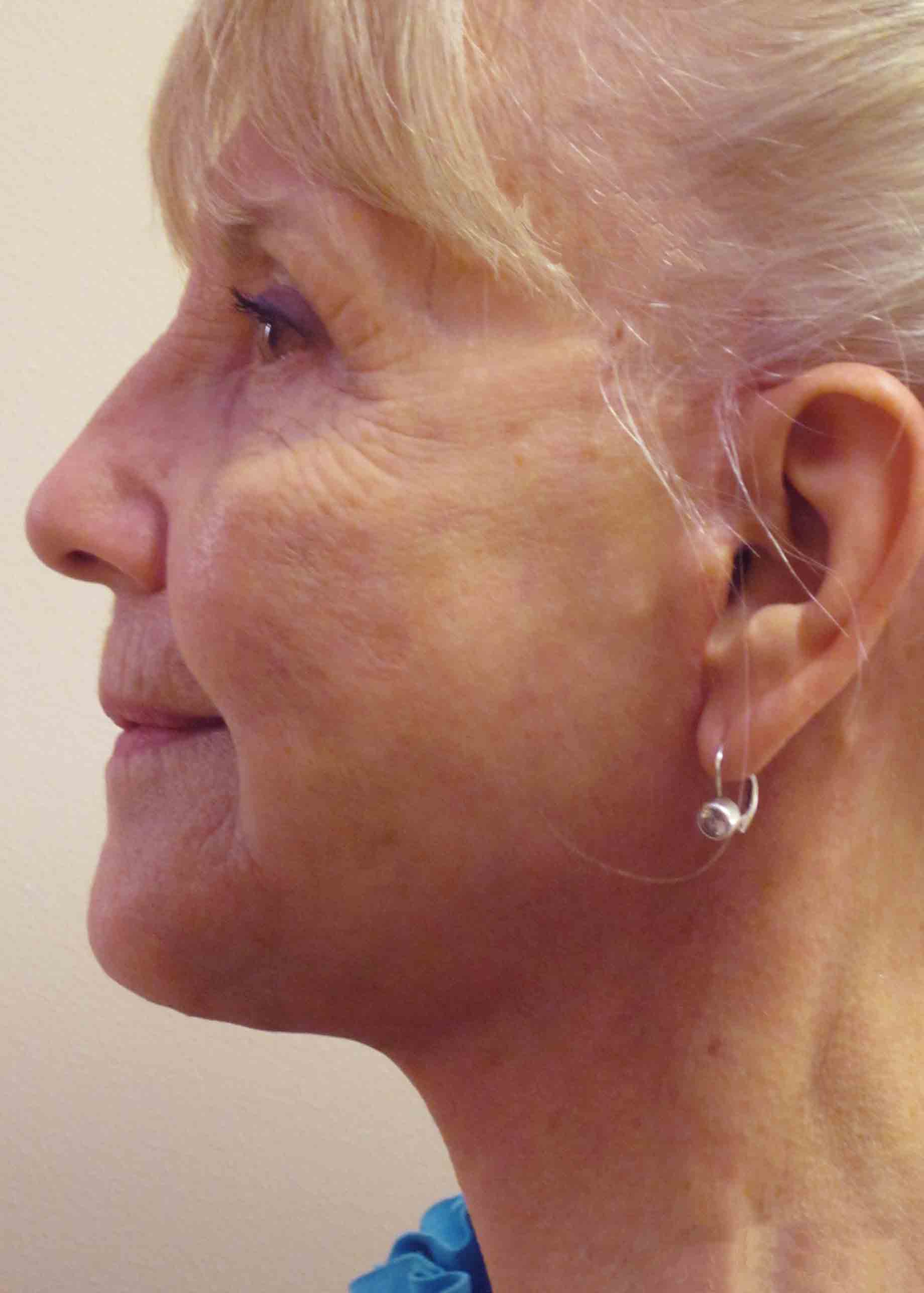 6296-4-post-op-facelift-profile.jpg