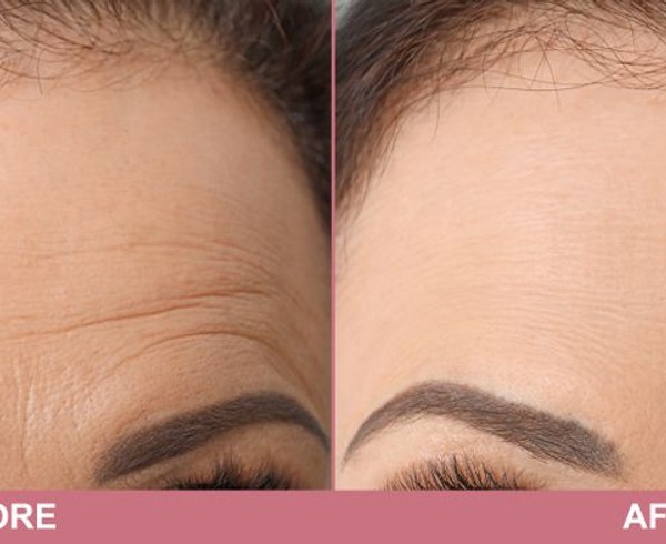 treatment for forehead wrinkles