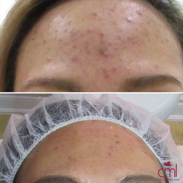 before-after-acne-1