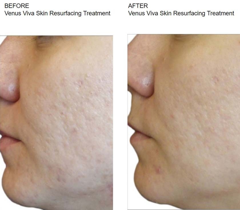 Before & After - skin resurfacing treatments