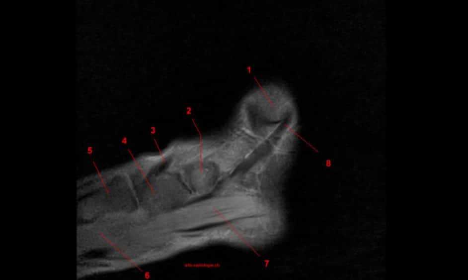 MRI of the Ankle: Detailed Anatomy