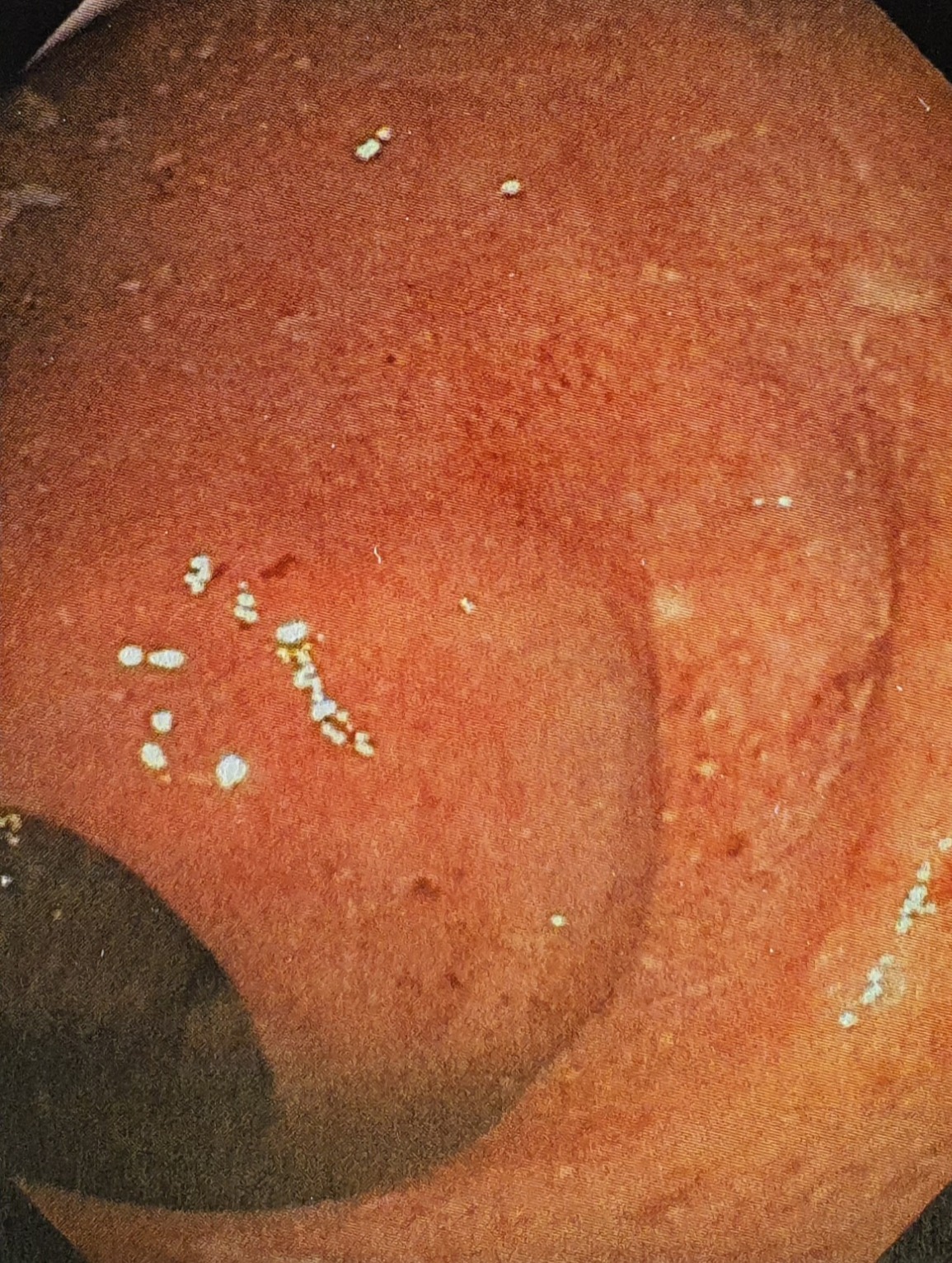Acute proctitis found on colonoscopy on February 20, 2018