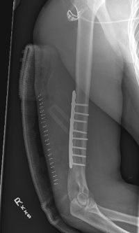 Humerus Fracture Repair in San Francisco by Dr. James Chen