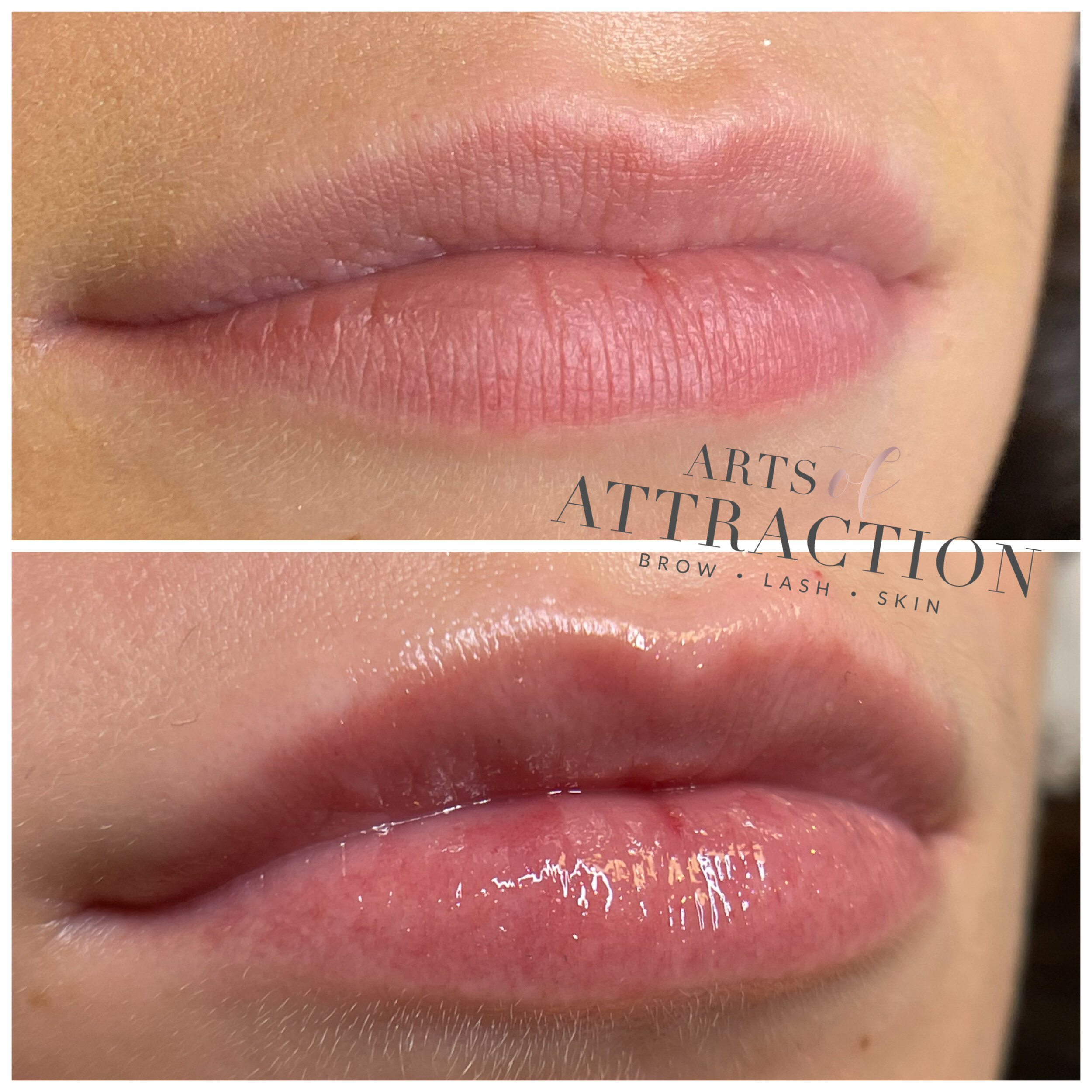 Hyaluronic Lip Infusion - Why Should I Get This?