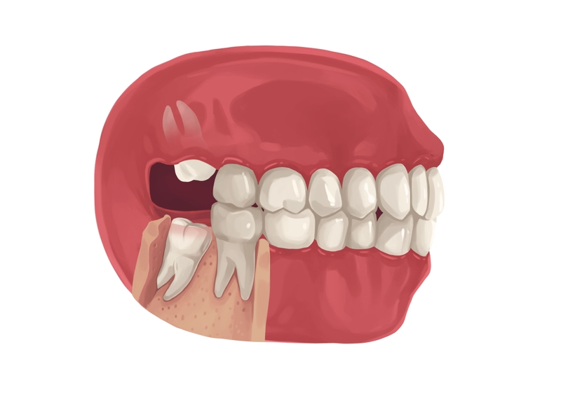 Wisdom tooth partially bony impaction