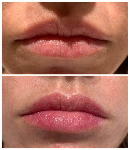 Arts of Attraction Hyaluronic Lip Infusion