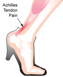 "Plantar