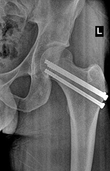 fracture repair neck femoral hip surgery screws