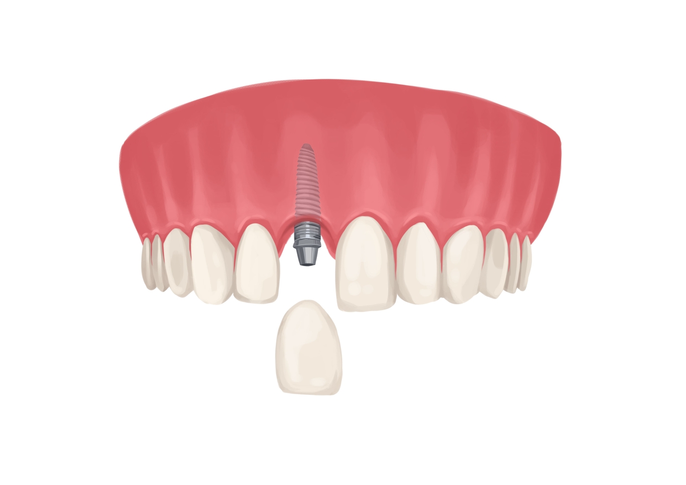 Dental bridge vs implant a comparison Authority Dental