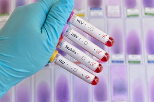 Sexually transmitted diseases HIV, HBV, HCV, Syphilis
