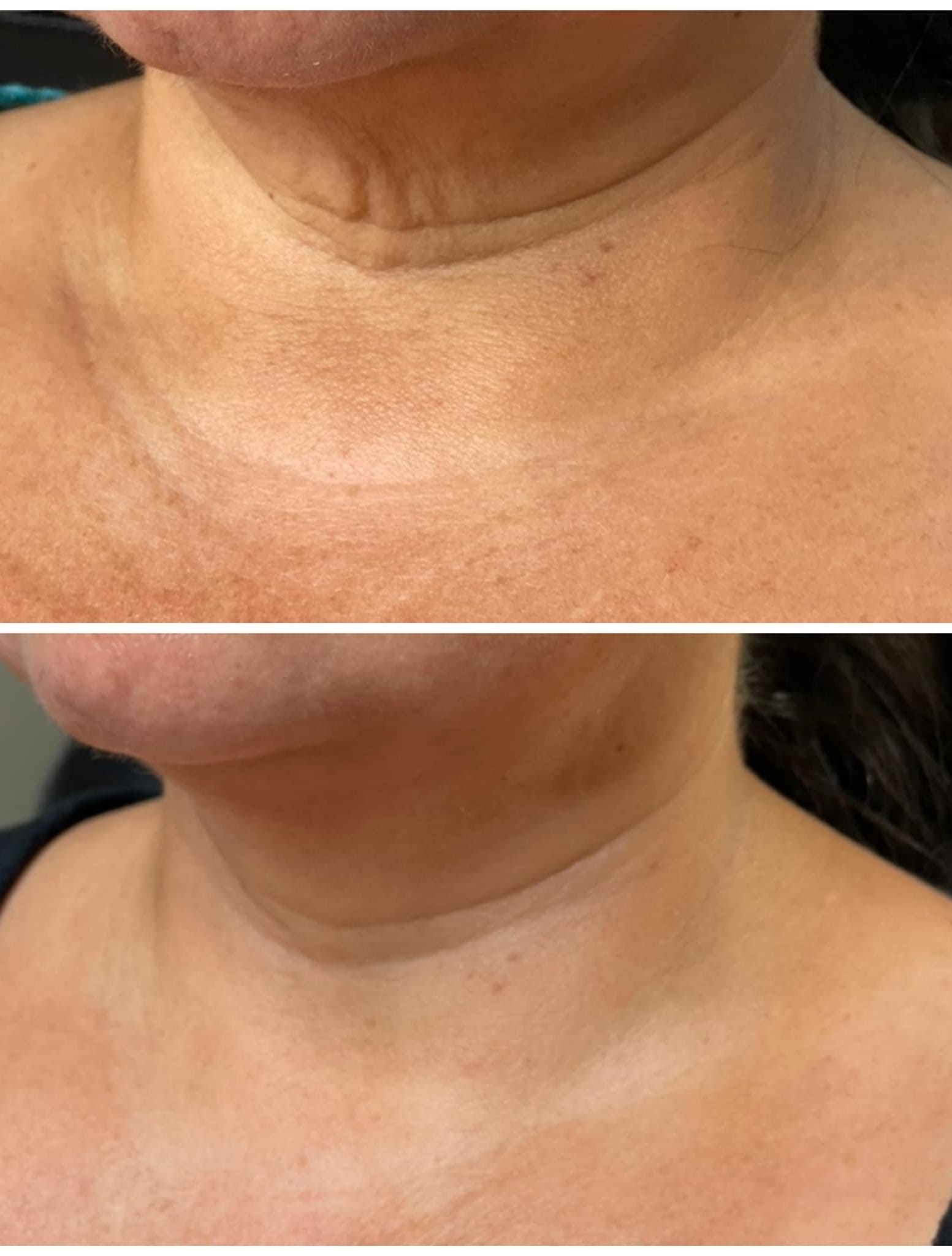Microneedling Before & After Treatment