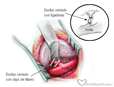 Ductus-cirugia