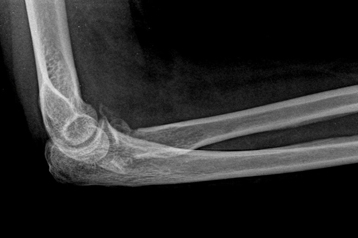 Elbow_fracture-Radial-Head-Pre-1.jpg