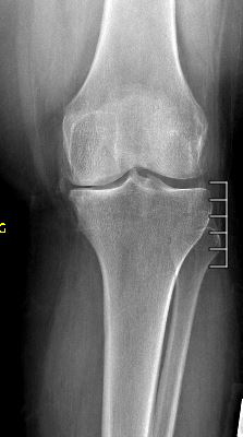 Medial_Compartment_Arthritis.JPG