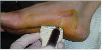"Plantar
