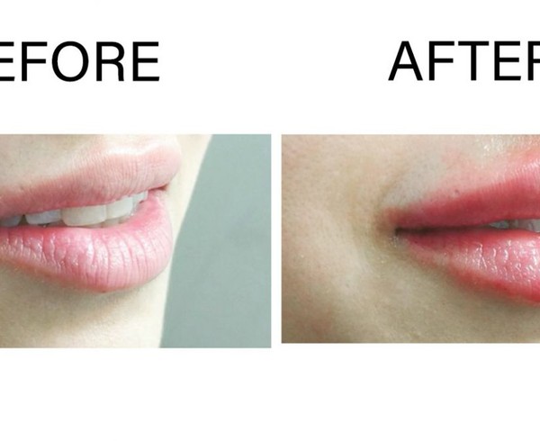 Lip Injections
