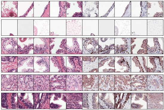 Example clusters. Some clusters capture a class perfectly, e.g. stroma in row 1 and 2 and tumor in row 5. Some clusters look similar but contain both benign epithelium and tumor (row 6).
