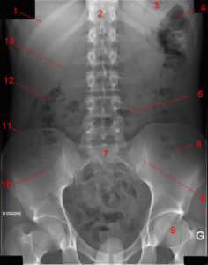 radiographie abdomen face 236x300