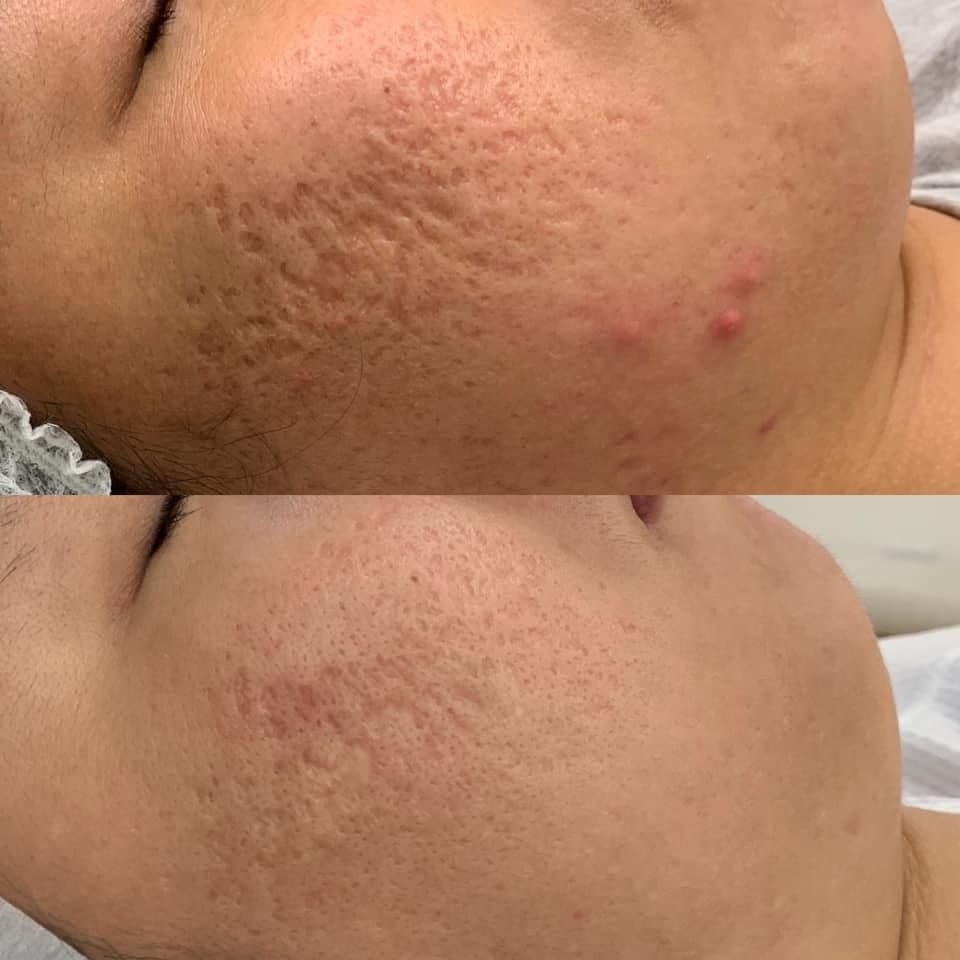 Microneedling Before & After Treatment at Essence of Beauty Ottawa