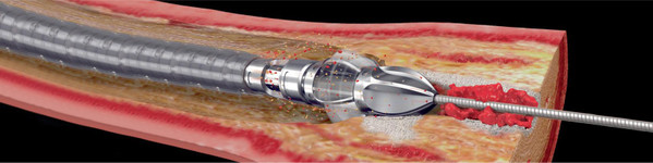 Procedura JetStream – sistem de aterectomie pentru dezobstrucția arterelor sever calcifiate