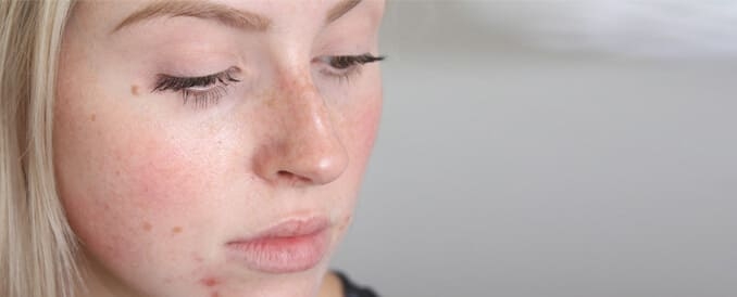 Essence of Beauty Ottawa - Holistic Acne Treatment