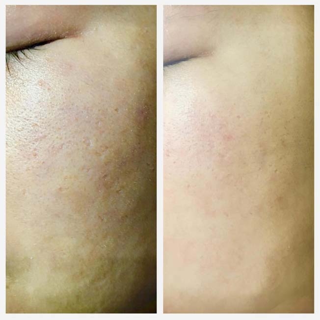 acne scars removal Maple
