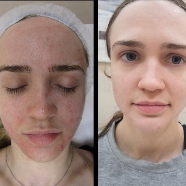 acne scars result
