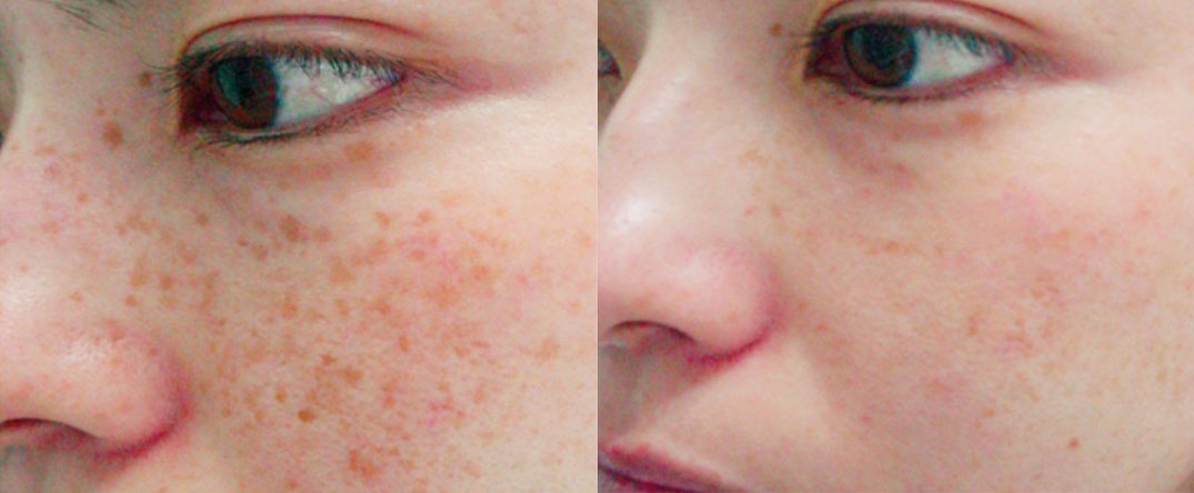 Hyperpigmentation treatment - before and after