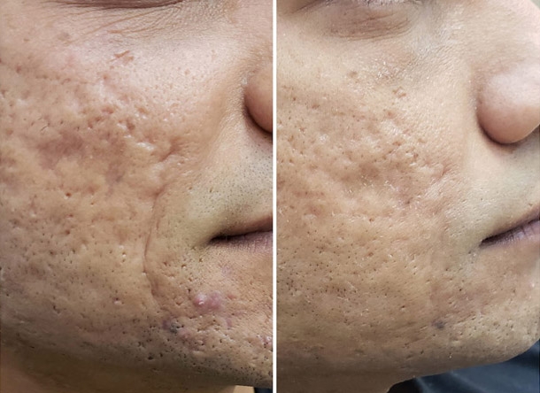 Before and after Microneedling