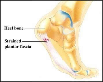 "Plantar