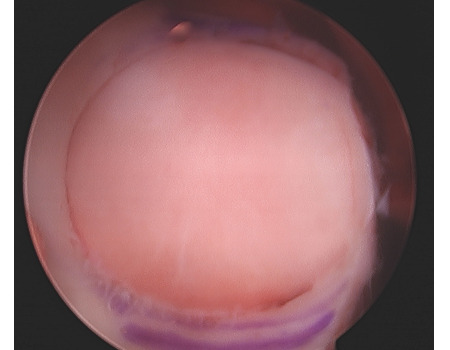 Arthroscopic_view_of_implanted_OATs.JPG